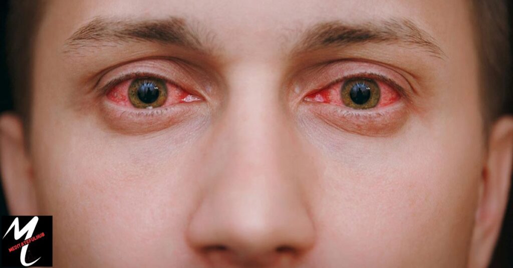 Causes of Popped Eye Vessels